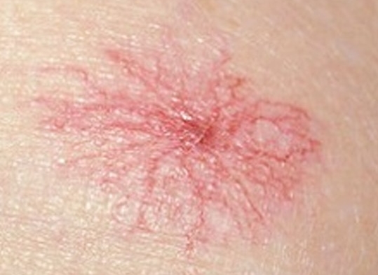 Một số ít những người mắc xơ gan thời kỳ đầu sẽ xuất hiện hiện tượng xuất huyết dạng mạng nhện. (ảnh: healthh.com)