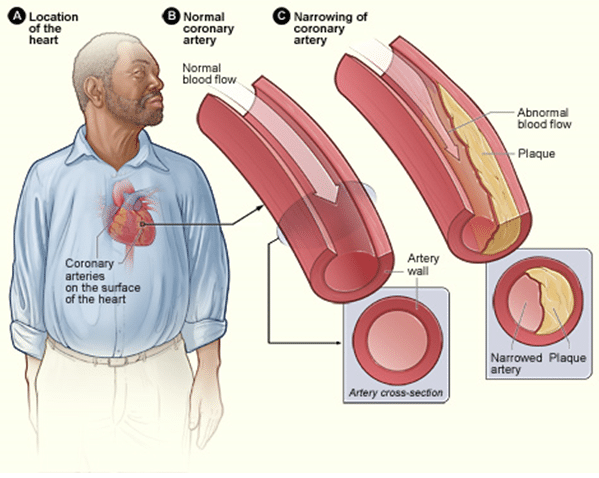 Coronary heart disease atherosclerosis