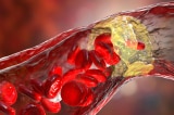 Các nhà khoa học lần đầu phát hiện mảng xơ vữa động mạch có thể biến mất hoàn toàn
